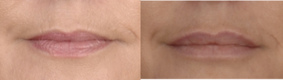 Juvederm before and after photo