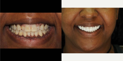 Porcelain Veneers before and after photo
