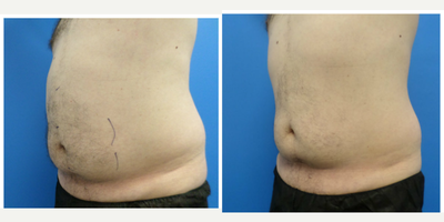 SculpSure before and after photo