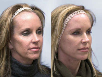 Thermage before and after photo
