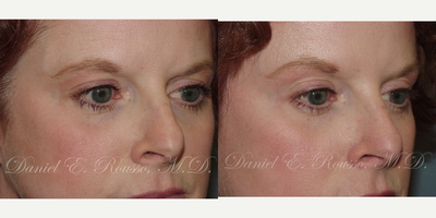 Botox before and after photo