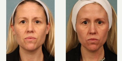 Chemical Peel before and after photo