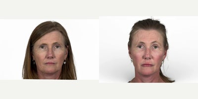 before and after image