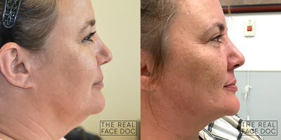 Neck Lift before and after photo