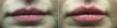 Juvederm before and after photo
