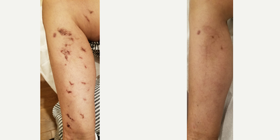 Skin Lightening before and after photo