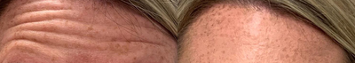 Botox before and after photo