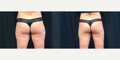 CoolSculpting before and after photo