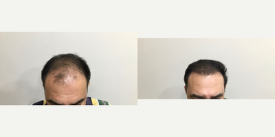 FUE Hair Transplant before and after photo