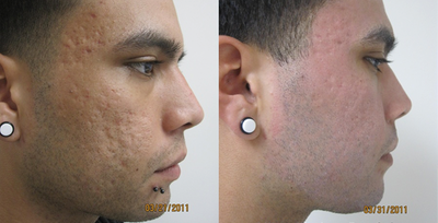 CO2 Laser before and after photo
