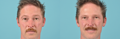 Eyelid Surgery before and after photo