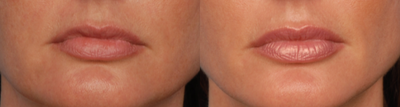 Lip Fillers before and after photo