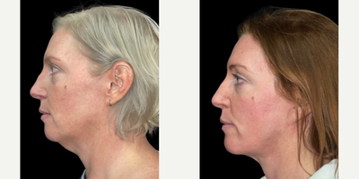 Neck Lift before and after photo
