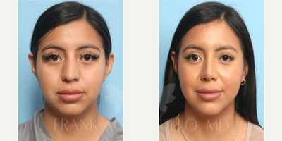 Rhinoplasty before and after photo