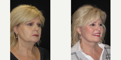 Brow Lift before and after photo