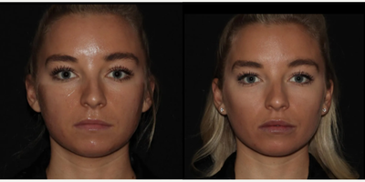Emface before and after photo