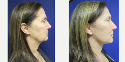 Facelift before and after photo