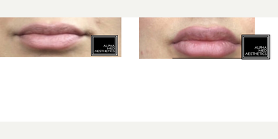 Juvederm before and after photo