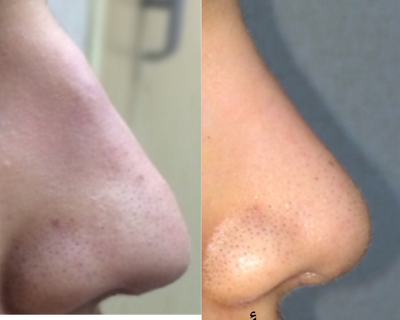 Rhinoplasty before and after photo