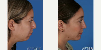 Rhinoplasty before and after photo