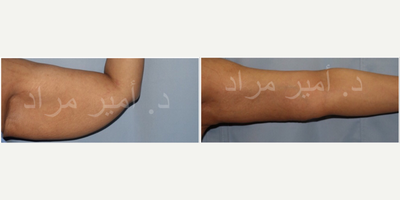 Arm Lift before and after photo