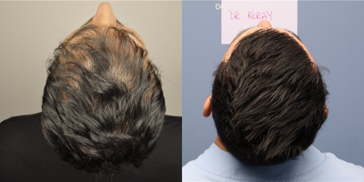 FUE Hair Transplant before and after photo
