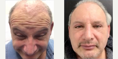 Botox before and after photo