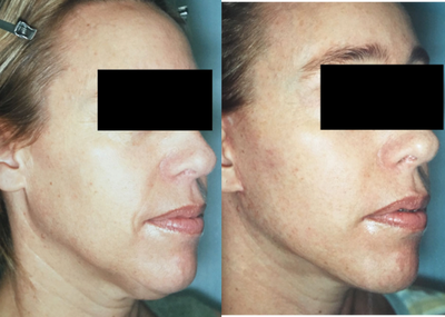 Facelift before and after photo