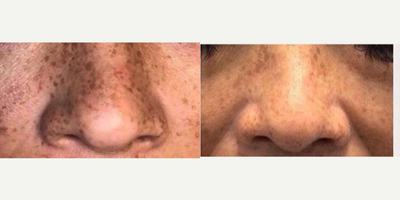 IPL before and after photo