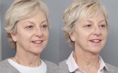 Juvederm before and after photo