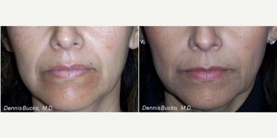 Restylane before and after photo
