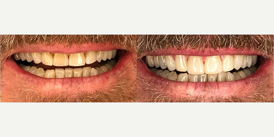 Smile Makeover before and after photo