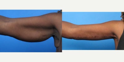 Arm Lift before and after photo