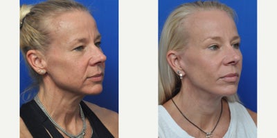 Bellafill before and after photo
