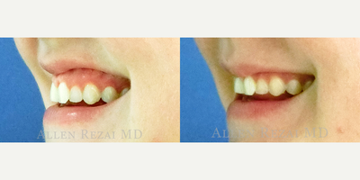 Botox before and after photo