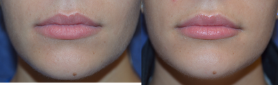 Lip Fillers before and after photo