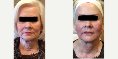 NovaThreads before and after photo
