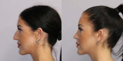 Rhinoplasty before and after photo
