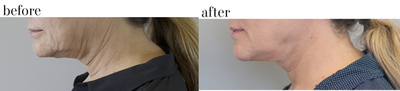 Neck Lift before and after photo