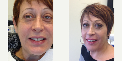 Porcelain Veneers before and after photo