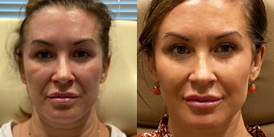 Thread Lift before and after photo