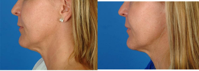 Ultherapy before and after photo