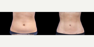 Abdominal Etching before and after photo