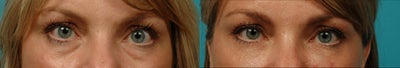 Restylane before and after photo