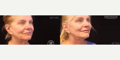 Rhinoplasty before and after photo