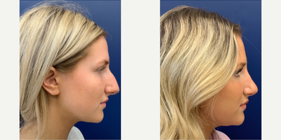 Rhinoplasty before and after photo