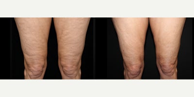 Venus Legacy before and after photo