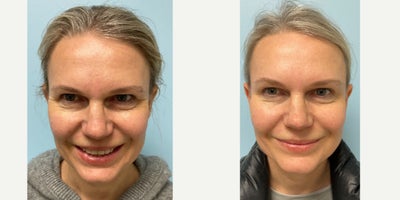 Botox before and after photo
