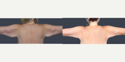 Breast Reduction before and after photo