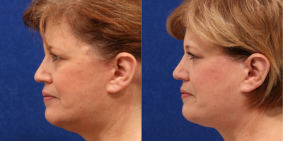 Facelift before and after photo
